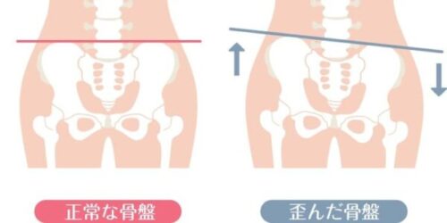 正常な骨盤と歪んだ骨盤の位置イメージ