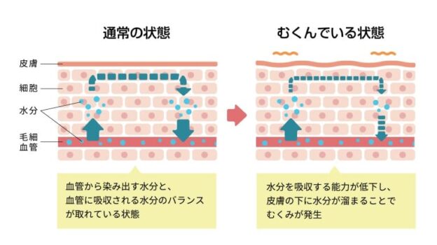 むくんでいる状態の体内の組織図