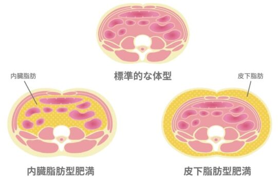 内臓脂肪型肥満と皮下脂肪型肥満