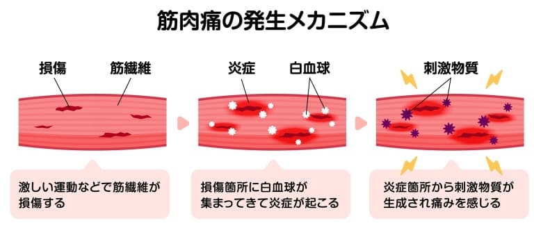 筋肉痛の発生メカニズム